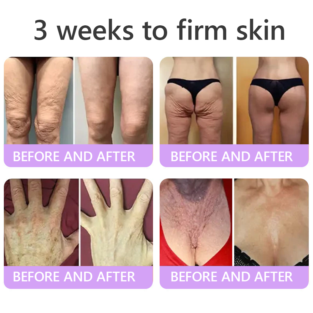 Enjoy an exclusive 30% discount: Yovot® PDRN Multi-Peptide Massaging Body Roller Cream- Anti-aging, Hydrating, Skin Firming & Lifting, Skin Repair, Even Tone, Acne and Dark Spot Treatment, Wart and Mole Removal, and Psoriasis Relief