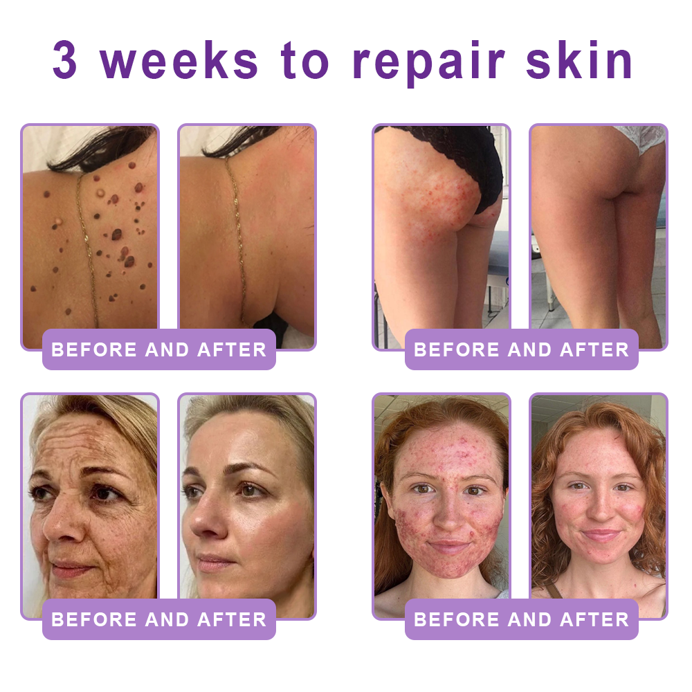 Enjoy an exclusive 30% discount: Yovot® PDRN Multi-Peptide Massaging Body Roller Cream- Anti-aging, Hydrating, Skin Firming & Lifting, Skin Repair, Even Tone, Acne and Dark Spot Treatment, Wart and Mole Removal, and Psoriasis Relief