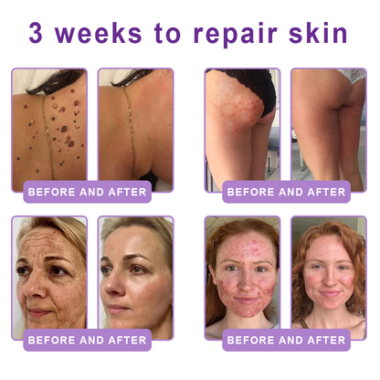Enjoy an exclusive 30% discount: Yovot® PDRN Multi-Peptide Massaging Body Roller Cream- Anti-aging, Hydrating, Skin Firming & Lifting, Skin Repair, Even Tone, Acne and Dark Spot Treatment, Wart and Mole Removal, and Psoriasis Relief
