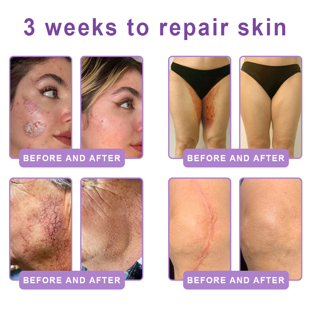 Enjoy an exclusive 30% discount: Yovot® PDRN Multi-Peptide Massaging Body Roller Cream- Anti-aging, Hydrating, Skin Firming & Lifting, Skin Repair, Even Tone, Acne and Dark Spot Treatment, Wart and Mole Removal, and Psoriasis Relief