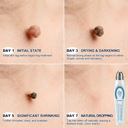Yovot®🩹🎉7-𝐷𝑎𝑦 𝗧𝐚𝐠 & 𝗦𝗽𝐨𝐭 𝐄𝐫𝒂𝒔𝒆𝒓(Zero Pain, Zero 𝐒𝐜𝐚𝒓𝒔 Rollerball)
